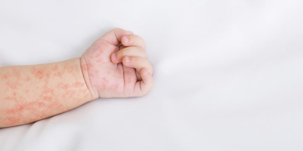 Półpasiec u dziecka